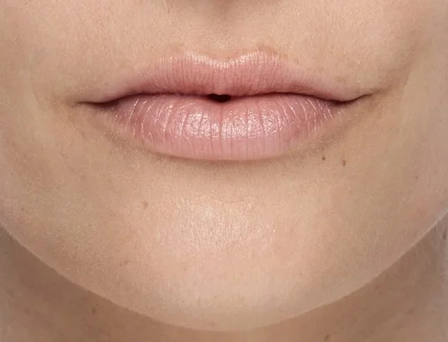 consumer_v3_restylane_lips_basmall_georgia_after.jpg