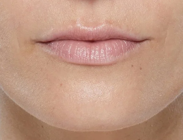 consumer_v3_restylane_lips_basmall_georgia_before.jpg