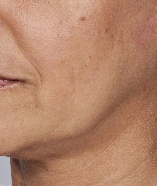 concerns_sagging_skin_whatisskinsagging