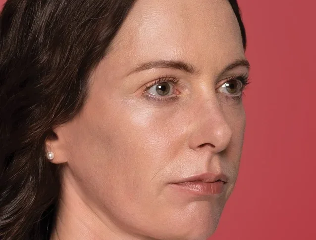 consumer_v3_restylane_cheeks_ba_caterina_before