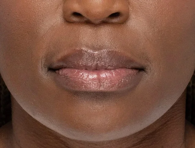 consumer_v3_restylane_lips
