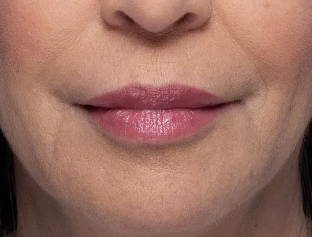 consumer_v3_restylane_lips