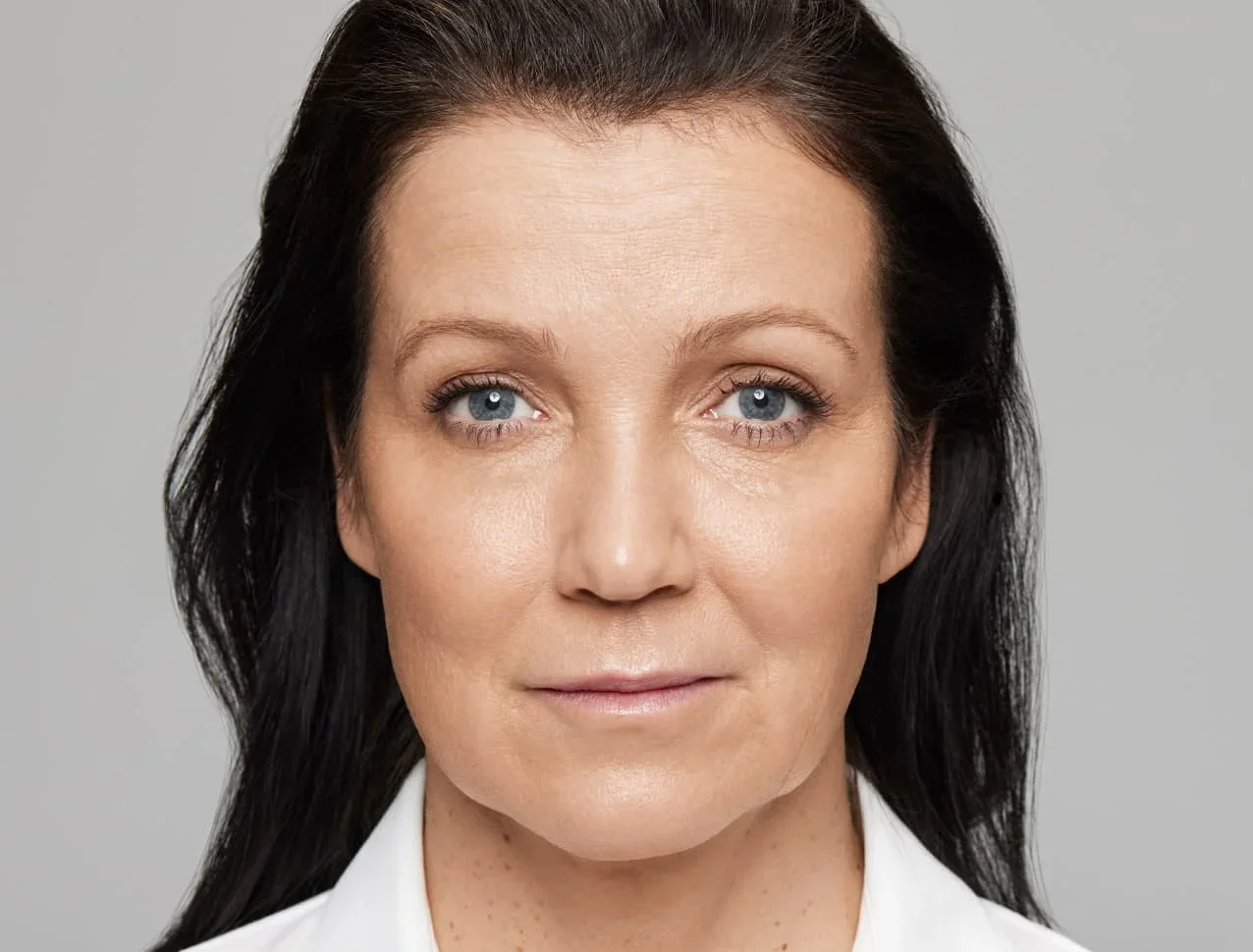 consumer_v3_skinboosters_face_basmall_mirjam_after