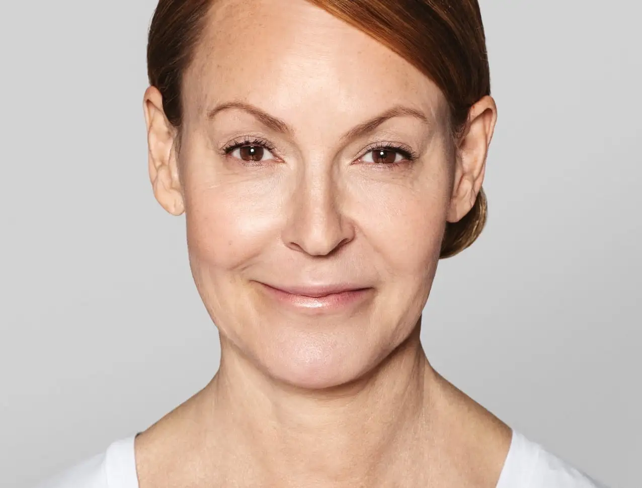 ANNIKA Tratamento com: RRestylane® SKINBOOSTERS VITAL™ 1ml/em 3 sessões