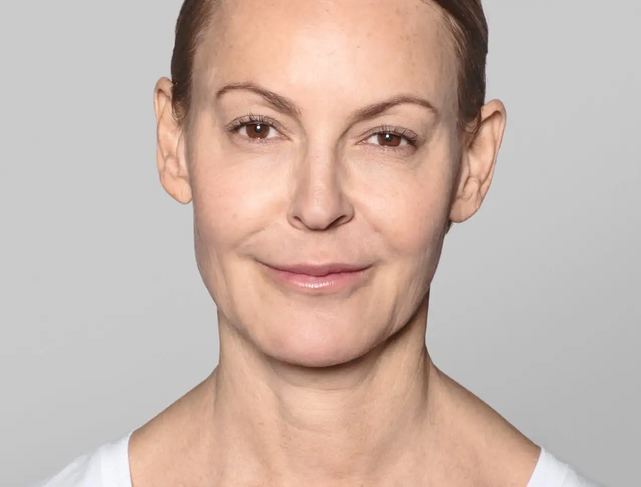 ANNIKA Tratamento com: RRestylane® SKINBOOSTERS VITAL™ 1ml/em 3 sessões