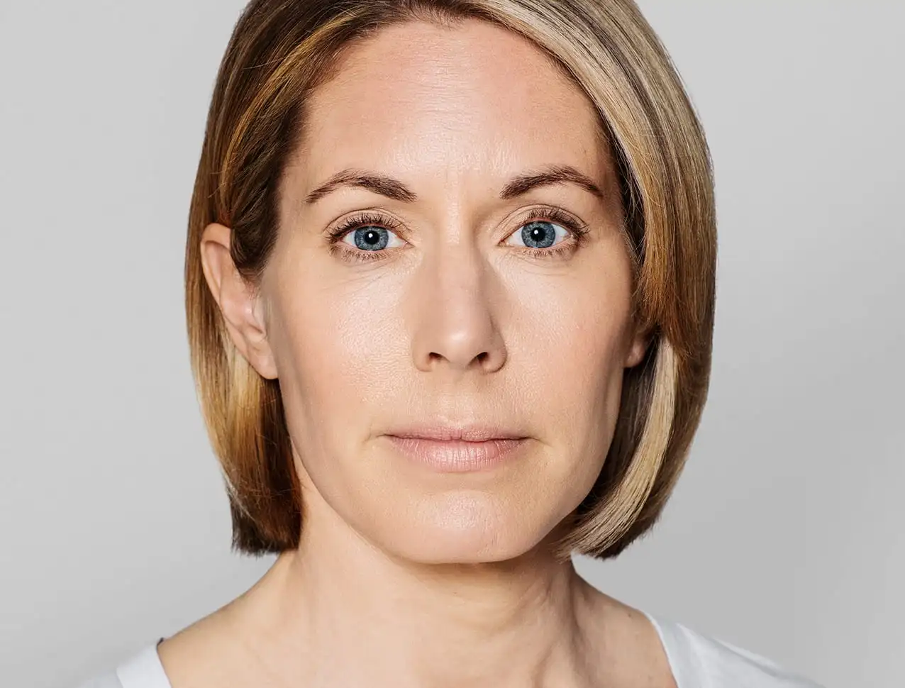 JENNY Tratamento com: Restylane® SKINBOOSTERS VITAL™ 1ml/em 6 sessões