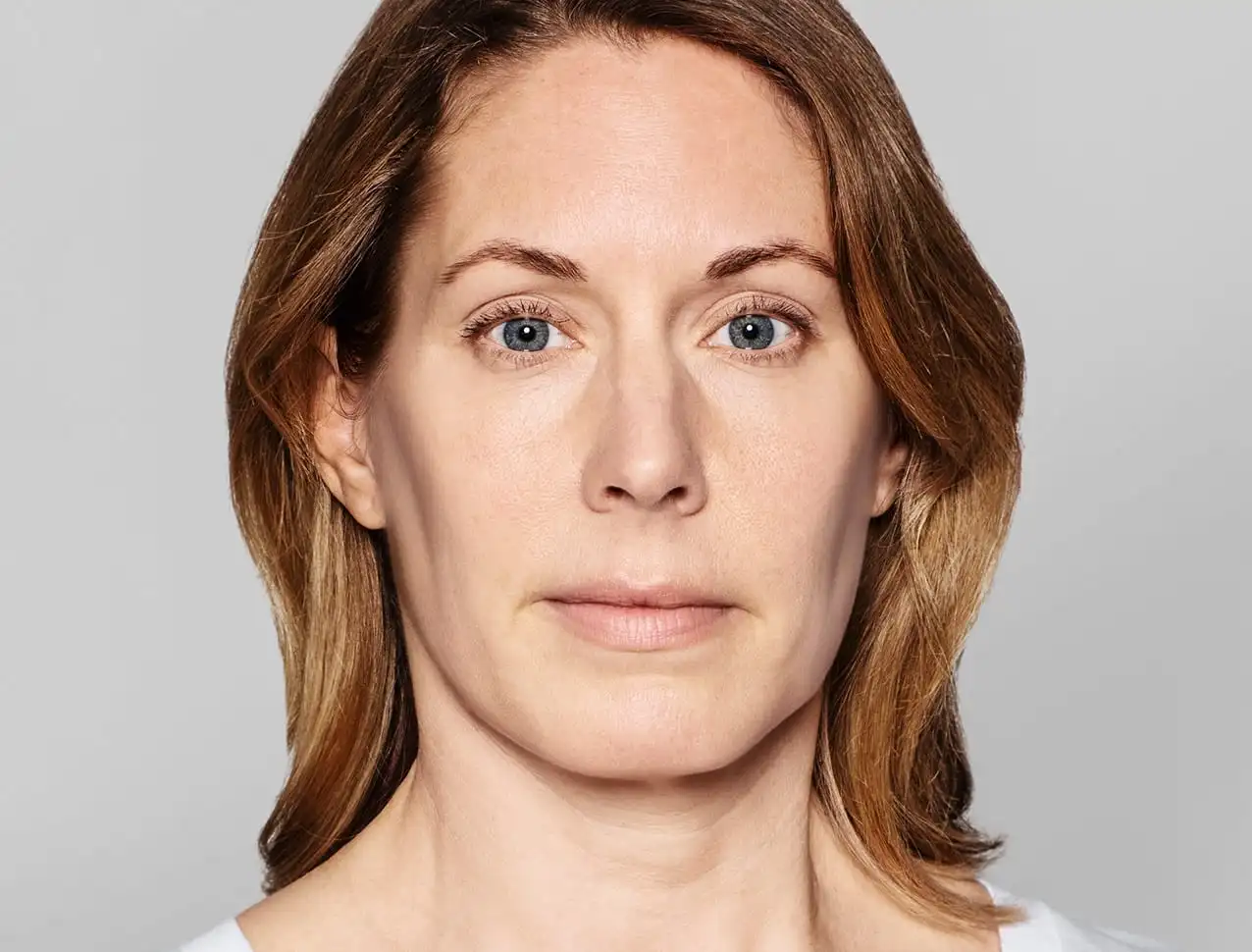 JENNY Tratamento com: Restylane® SKINBOOSTERS VITAL™ 1ml/em 6 sessões