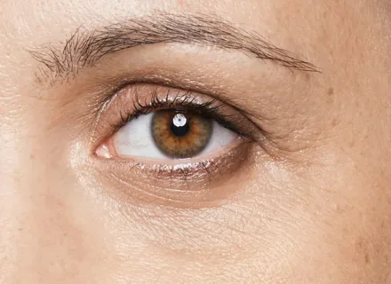 Dark circles under eyes