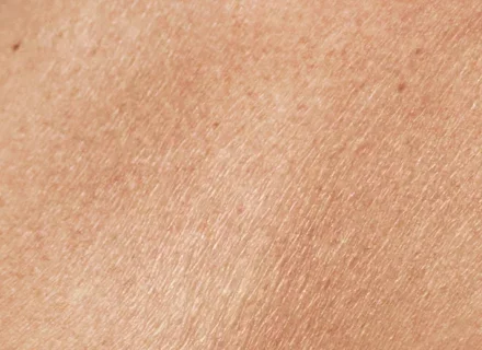 dry_skin