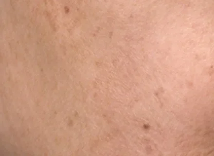 pigmentation