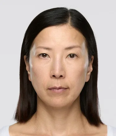 sculptra_ba_youni_after12months