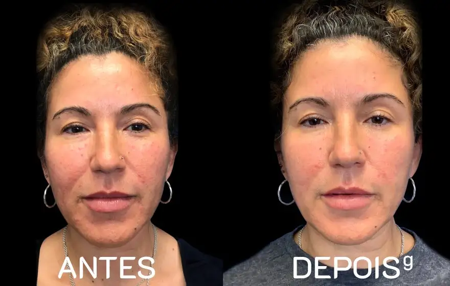 Uma imagem lado a lado mostra o antes e depois do rosto de uma mulher. Na imagem 