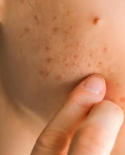 mulher-adulta-acne